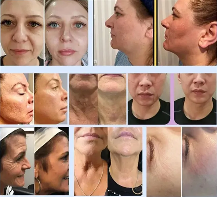 MPT 12D HIFU Machine